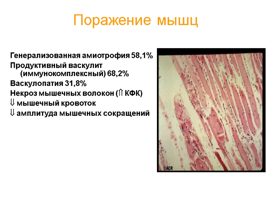 Поражение мышц Генерализованная амиотрофия 58,1% Продуктивный васкулит (иммунокомплексный) 68,2% Васкулопатия 31,8% Некроз мышечных волокон